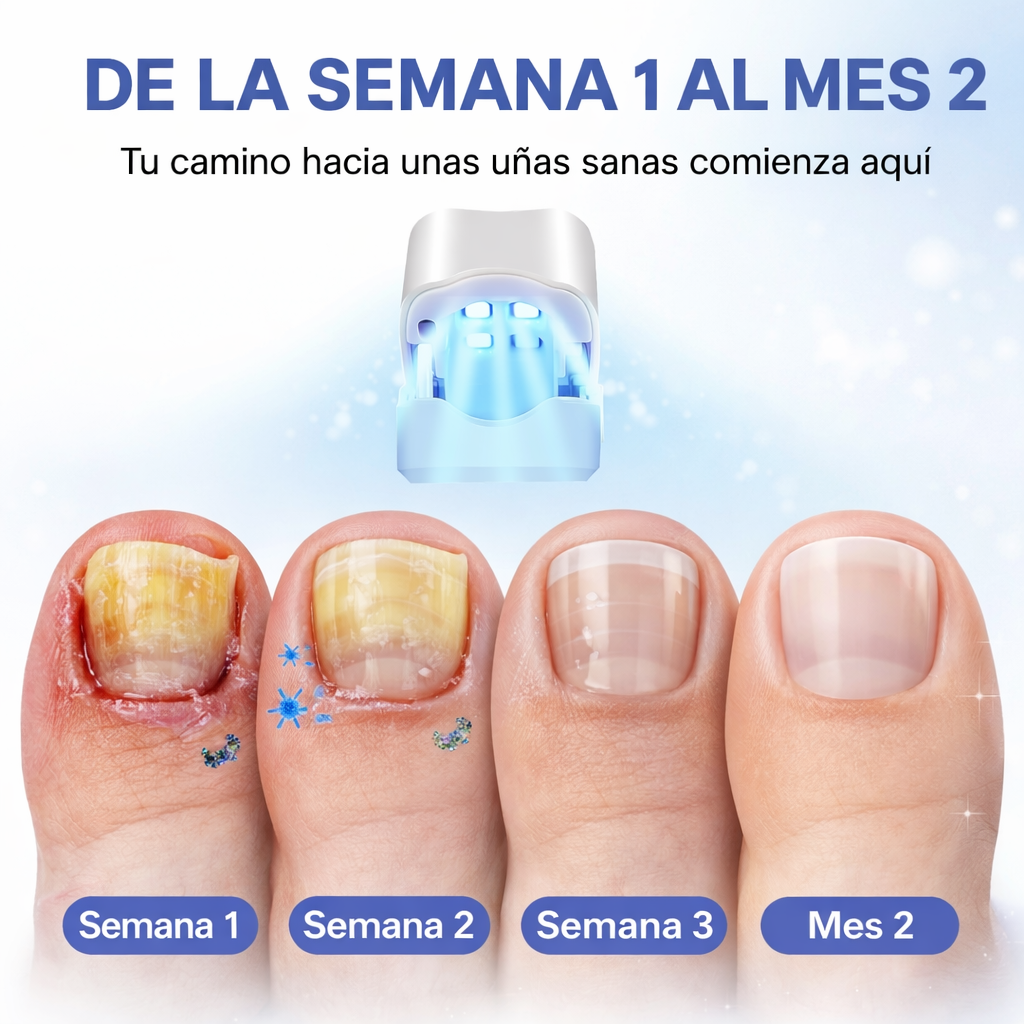 Dispositivo Laser Elimina Hongos™ Uñas Saludables Desde Casa